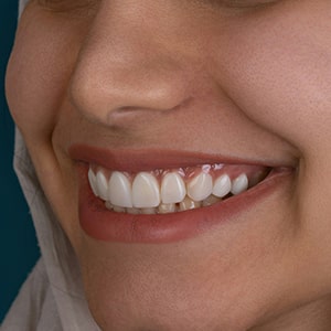 درمان ریشه